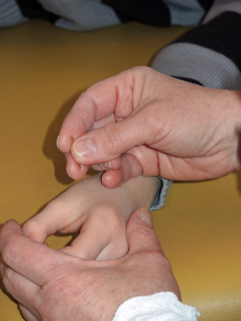 Foto von einer Akupunktur-Anwendung